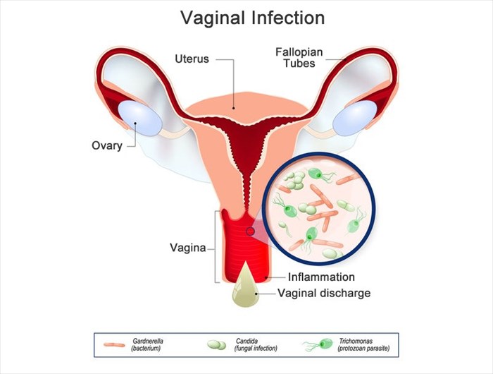 Vaginal Discharge: What's Abnormal, Colors, Infections & Treatment - Doctor  Zara