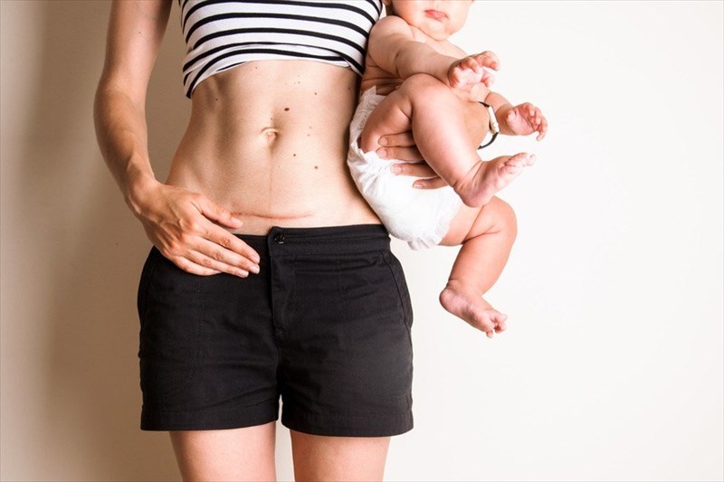 8 Natural C-Section Recovery Tips to Help You Heal - Motherly