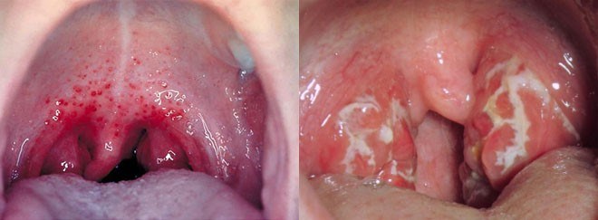 strep throat white spots on tonsils