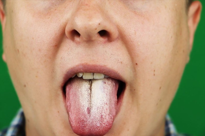 Oropharyngeal Oesophageal Candidiasis Also Known As Oral Thrush