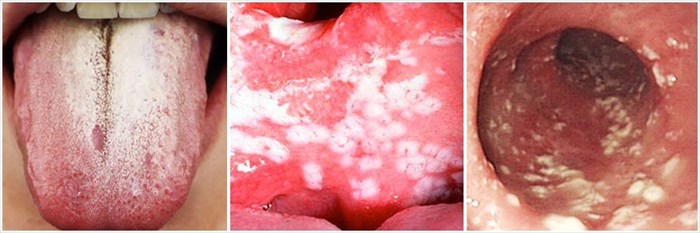 oropharyngeal candidiasis