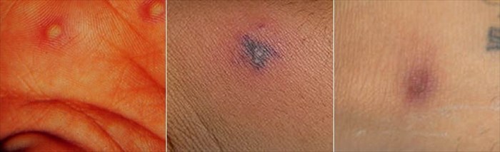 What is a Gonorrhoea rash?