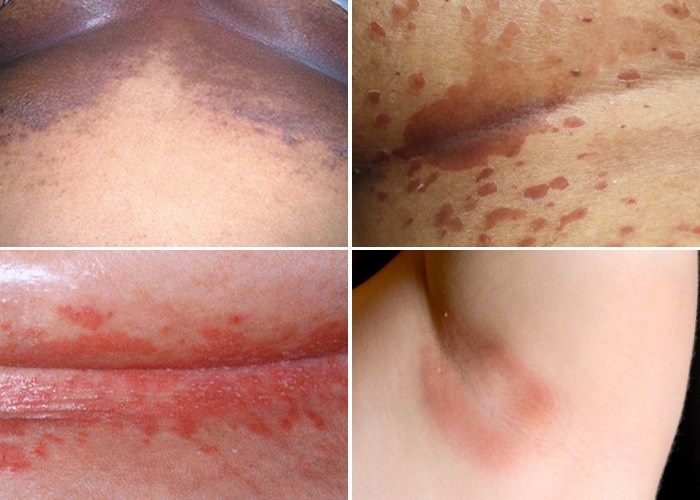 Candidiasis of the Skin: Causes, Symptoms, and Treatment