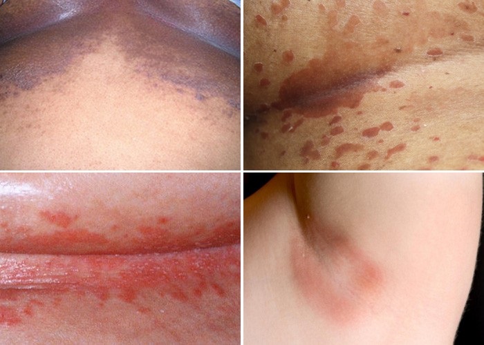 Candidiasis yeast deals infection on skin