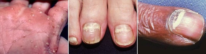 Cutaneous Candidiasis / Candida Skin Infection