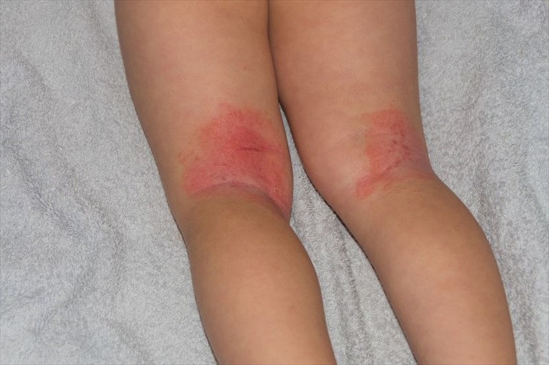 fungal skin rash