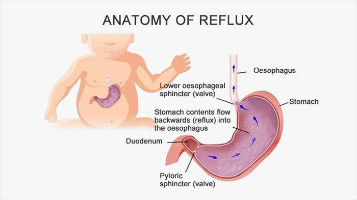 acid reflux in babies