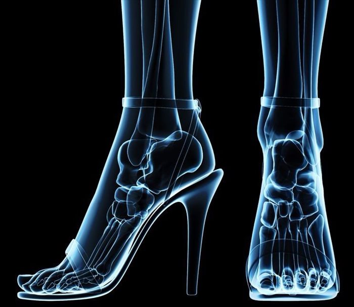 Cinderella Surgery – The stiletto surgery for your feet