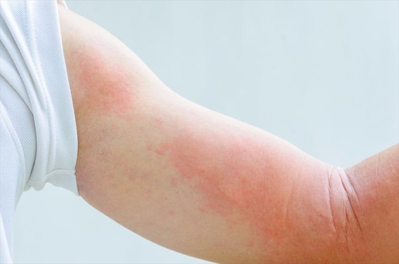 Scarlet Fever: Symptoms, Causes and Best Treatment