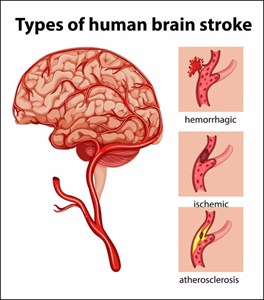 different types of strokes