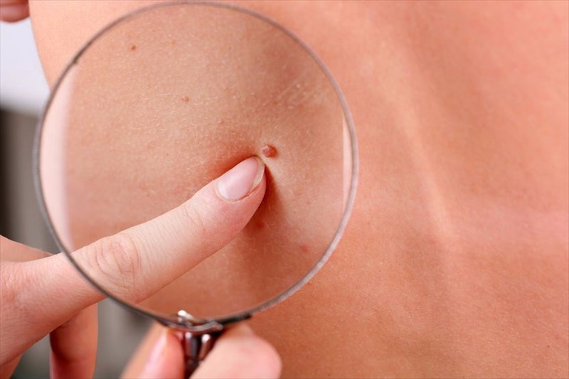 cancerous skin tags