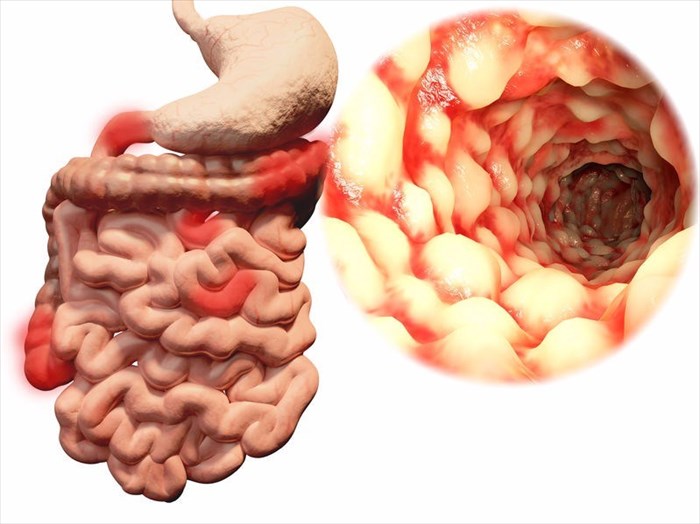 How does Crohn's disease affect the intestines?