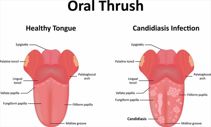 Oral deals thrush throat