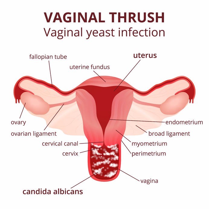 candidal vaginitis