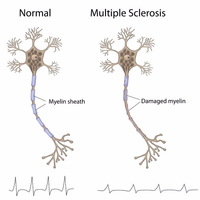 About ALS/MND/ELA